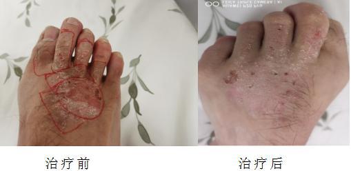 贴在身上的血管瘤治疗利器 锶 90敷贴器