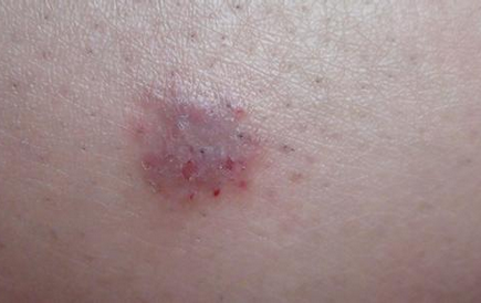 皮肤癌症状图片