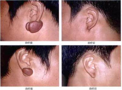 跟瘢痕疙瘩、皮肤血管瘤说拜拜--放射性核素敷贴治疗