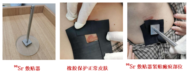 瘢痕疙瘩又丑、又痒、又痛怎么办?它的&ldquo;克星&rdquo;来了