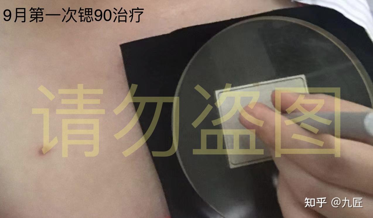 疤痕疙瘩-同位素治疗尝试 - 